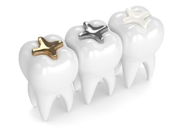 Dental Fillings FAQ's